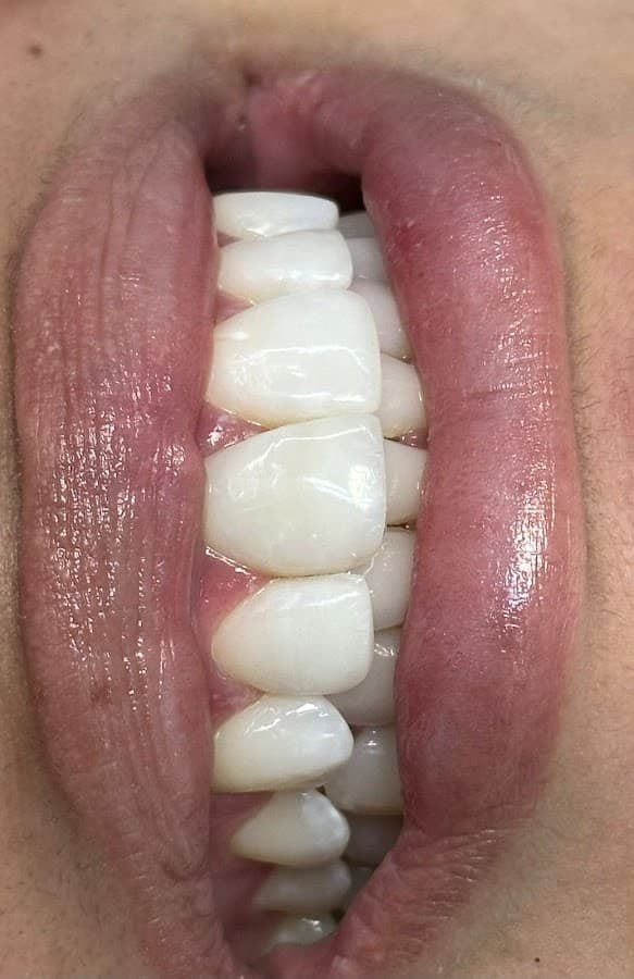 Imagem foca nos dentes durante o atendimento odontológico.